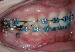 kotevni implantat pro miniaturu